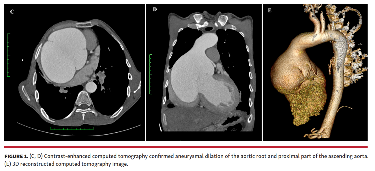 Aortic Root Aneurysm
